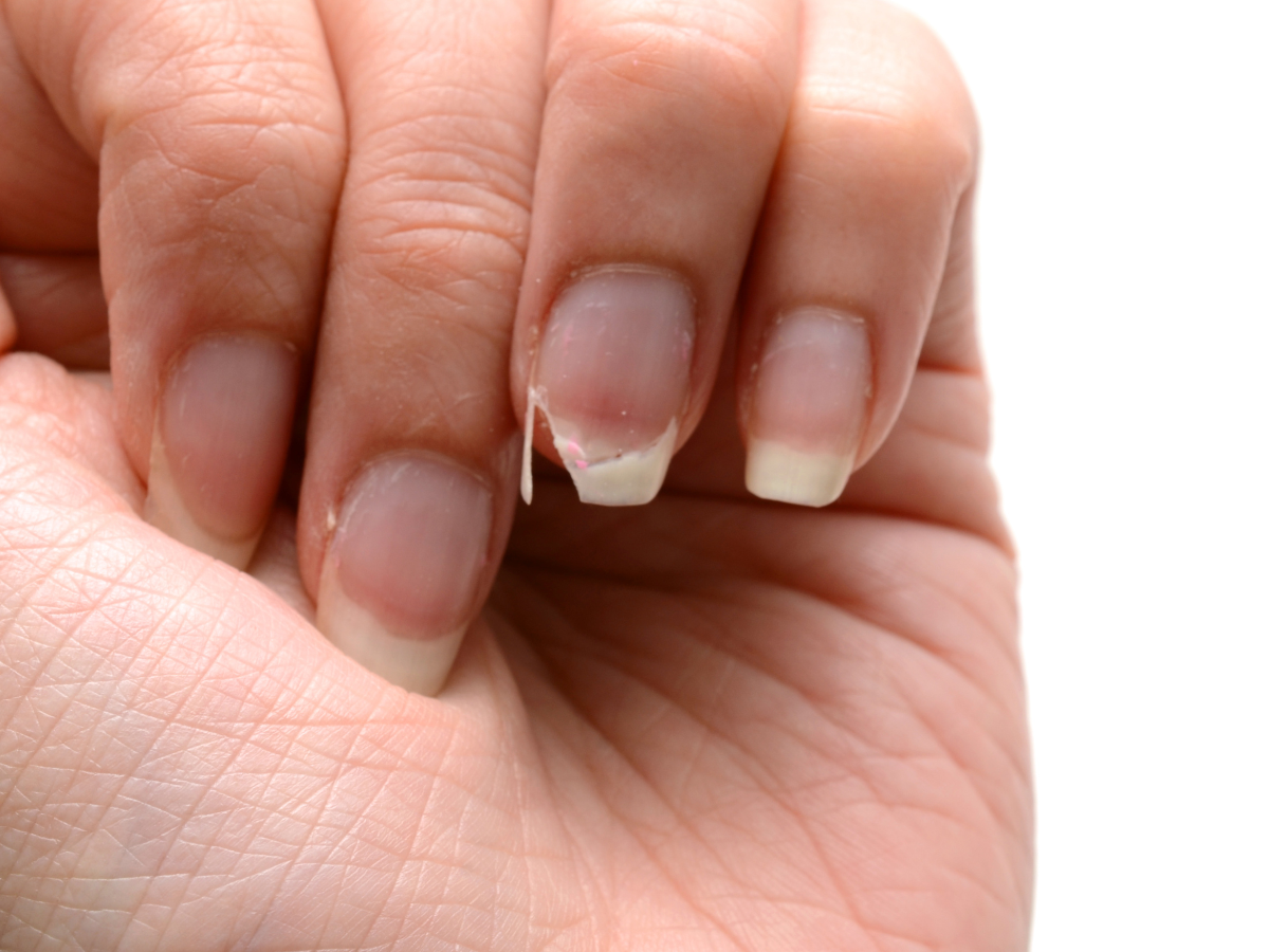 Síndrome das Unhas Frágeis. Foto unha da mão quebrada