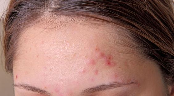 espinhas x chocolate 2