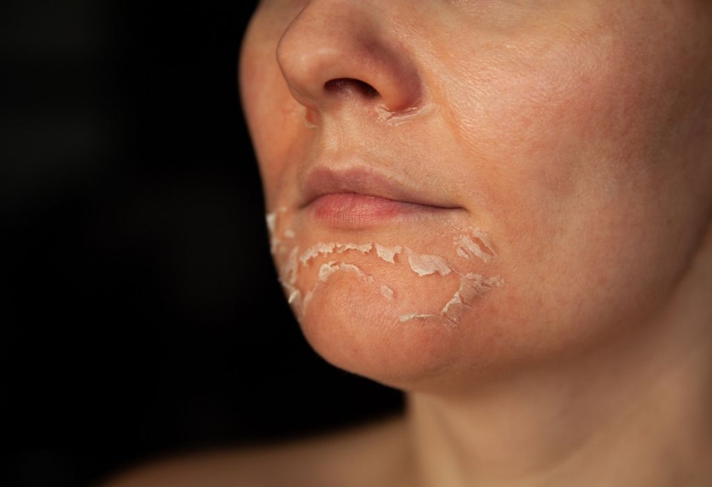 Erros pele madura tratamentos agressivos